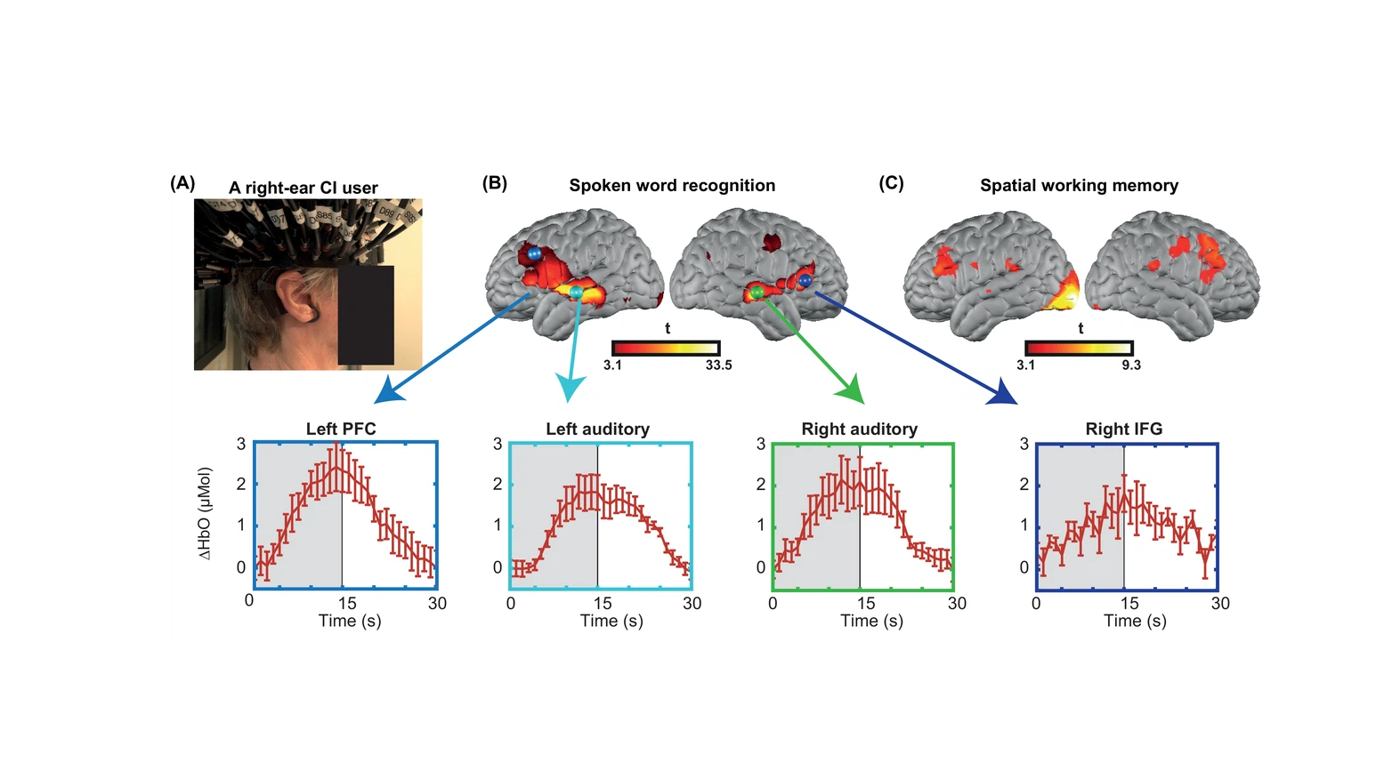 Prefrontal cortex supports speech perception in listeners with cochlear implants