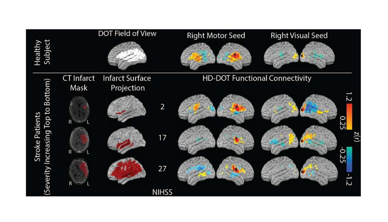 Bedside diffuse optical tomography of disrupted brain connectivity during acute stroke